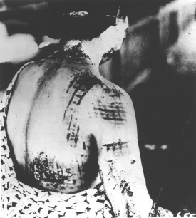 Kimura Kenichi, The patient’s skin is burned into a pattern