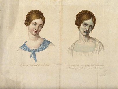 V0010485 A young Venetian woman, aged 23, depicted before and after cholera